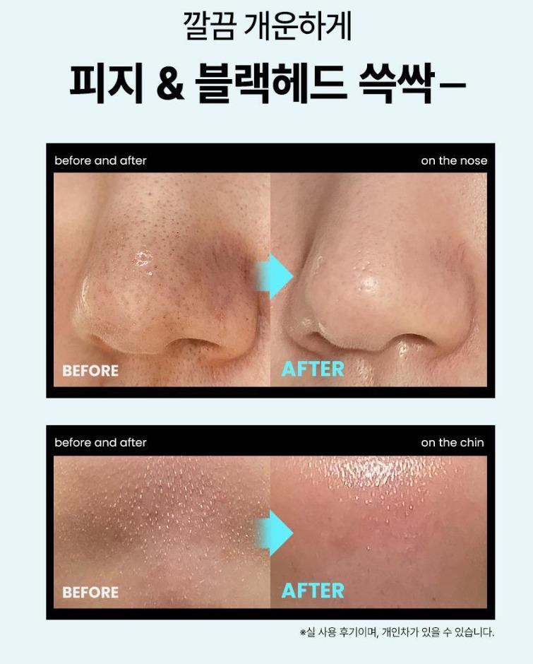 🇰🇷韓國 直送 ilso Super Melting Sebum Softener 黑頭粉刺溶解液套裝 **# *因導出液會因飛機氣壓而有機會些少滲漏，不喜勿訂🙈*